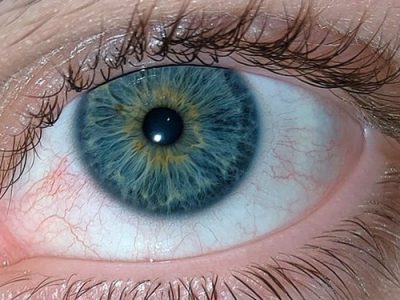 آبی رنگ شدن سفیدی چشم کودک نشانه چیست؟